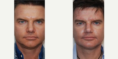 Chin Implant before and after photo