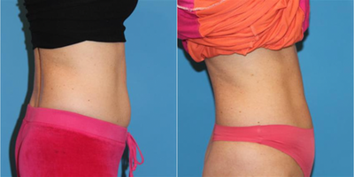 CoolSculpting before and after photo