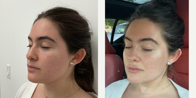 Lip Fillers before and after photo