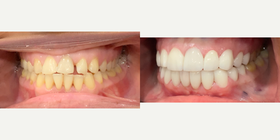 Porcelain Veneers before and after photo