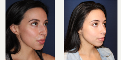 Rhinoplasty before and after photo