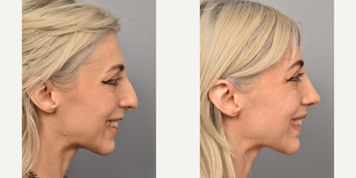 Rhinoplasty before and after photo