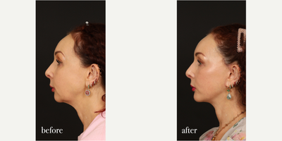 Chin Implant before and after photo