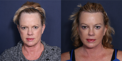 Facelift before and after photo
