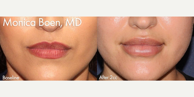 Lip Fillers before and after photo