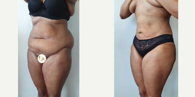 Liposculpture before and after photo