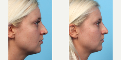 Nonsurgical Nose Job before and after photo