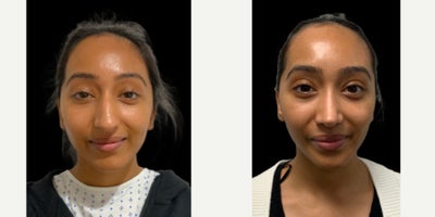 Rhinoplasty before and after photo