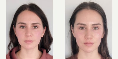 Dermal Fillers before and after photo