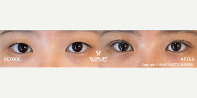 Double Eyelid Surgery before and after photo