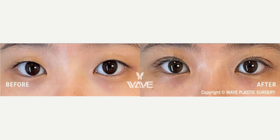 Double Eyelid Surgery before and after photo