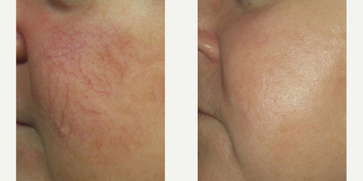 IPL before and after photo
