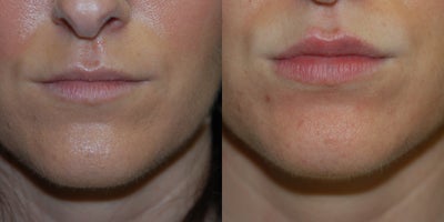 Restylane before and after photo