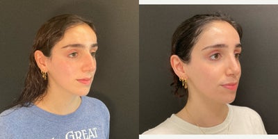 Rhinoplasty before and after photo
