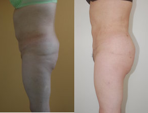 Butt Augmentation before and after photo