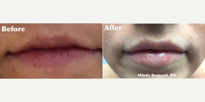 Dermal Fillers before and after photo