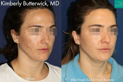 Fraxel Laser before and after photo