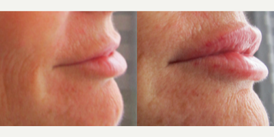 Lip Fillers before and after photo