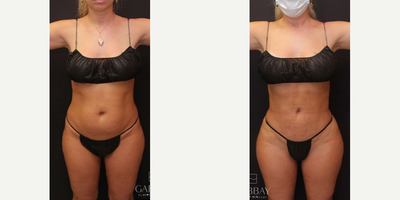 Liposculpture before and after photo