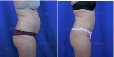 Liposuction before and after photo