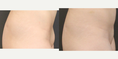 Liposuction before and after photo