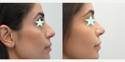 Rhinoplasty before and after photo