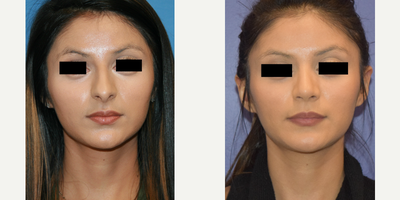 Rhinoplasty before and after photo