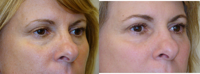 ActiveFX before and after photo