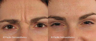 Botox before and after photo