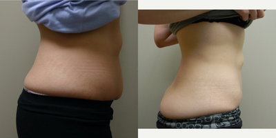CoolSculpting before and after photo
