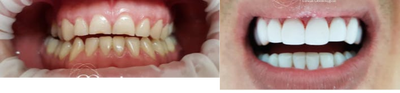 Dental Implants before and after photo
