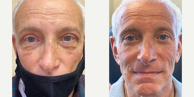Double Eyelid Surgery before and after photo