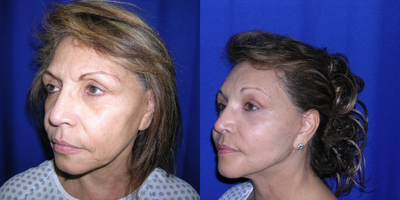 Facelift before and after photo