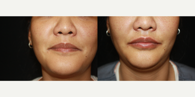 Lip Fillers before and after photo