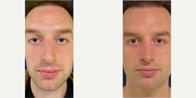 Rhinoplasty before and after photo