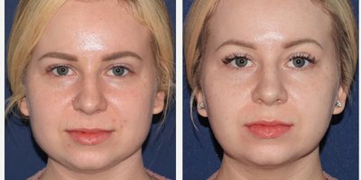 Botox before and after photo