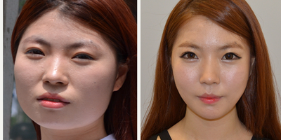 Genioplasty before and after photo