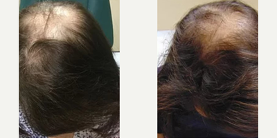 PRP for Hair Loss before and after photo