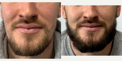 Beard Transplant before and after photo