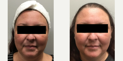Halo Laser before and after photo