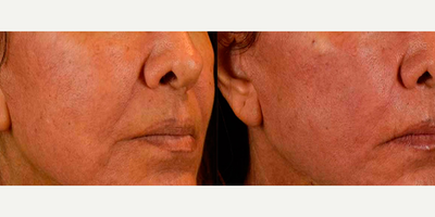 Thread Lift before and after photo
