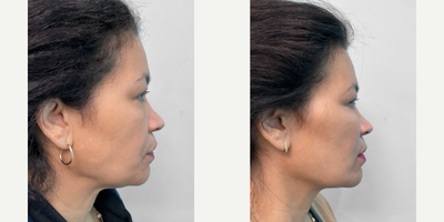 Dermal Fillers before and after photo