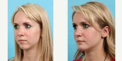 Genioplasty before and after photo
