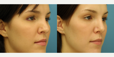 Revision Rhinoplasty before and after photo
