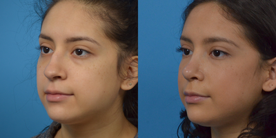 Rhinoplasty before and after photo