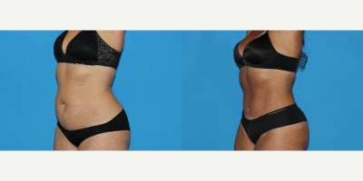 Tummy Tuck before and after photo