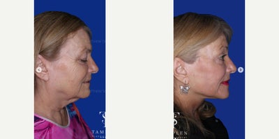 Brow Lift before and after photo