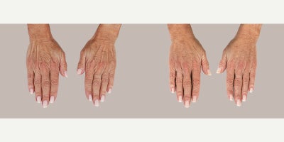 Hand Rejuvenation before and after photo