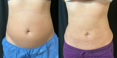 Laser Liposuction before and after photo