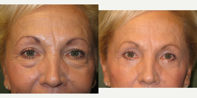 Eyelid Surgery before and after photo